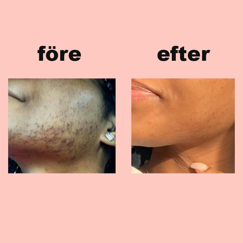 Speciell Hårborttagningskräm För Hårborttagning I Ansiktet/Depilatory cream for facial hair removal